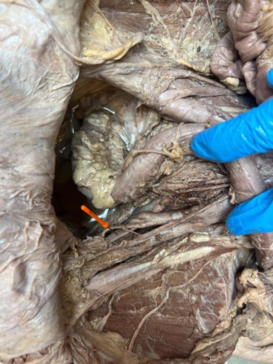 <p>external iliac vain</p>