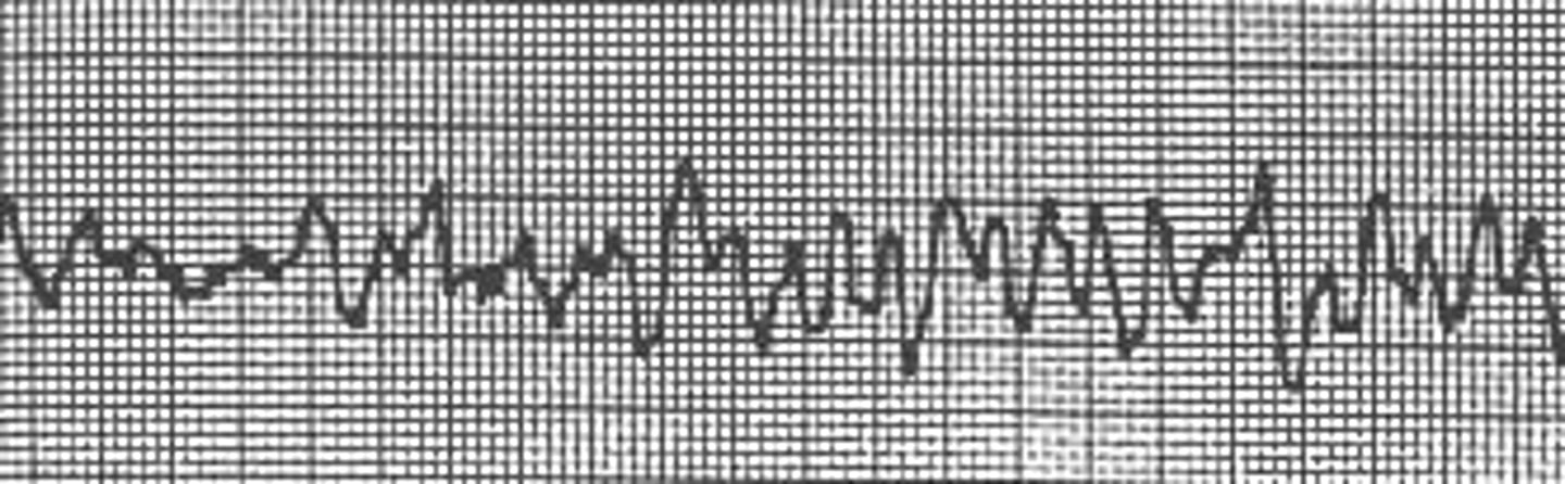 <p>350-450</p><p>- "chaotic"</p><p>- mult vent foci rapidly discharging -&gt; erratic vent rhythm</p><p>- no identifiable waves</p><p>- RESPOND IMMEDIATELY!</p><p>- no pulse or perfusion, pt=dead</p>