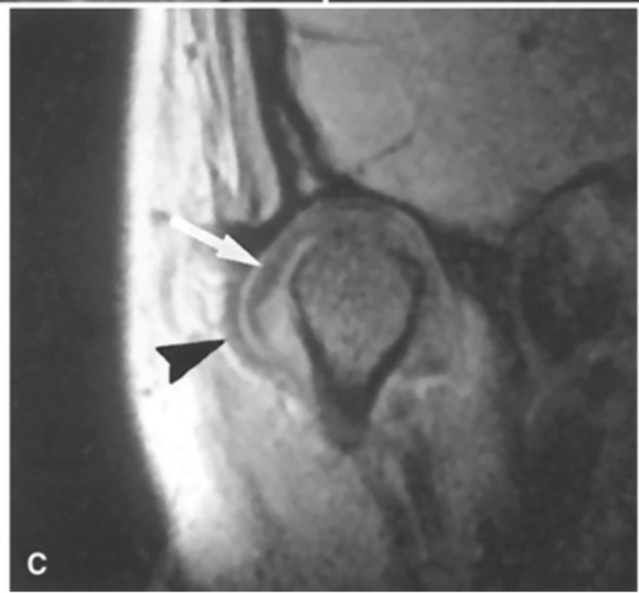 <p>The MRI is showing the disc ________ ______</p>