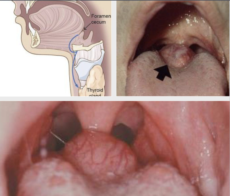 <p><span style="color: #000000">normal thyroid on posterior midline dorsum of the tongue posterior to the circumvallate papillae in the area of the foramen cecum</span></p>