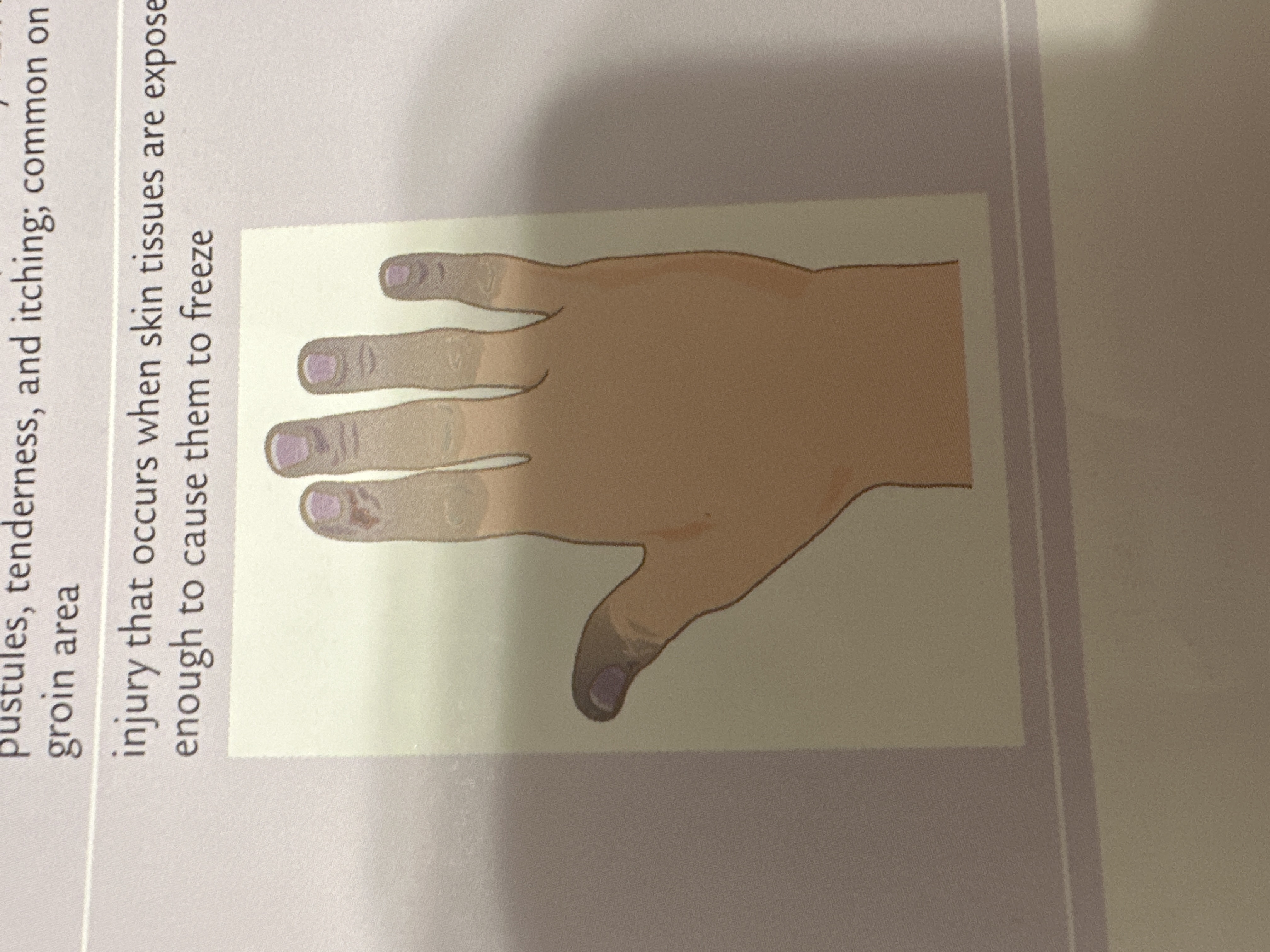 injury that occurs when skin tissues are exposed to temperatures cold enough to cause them to freeze
