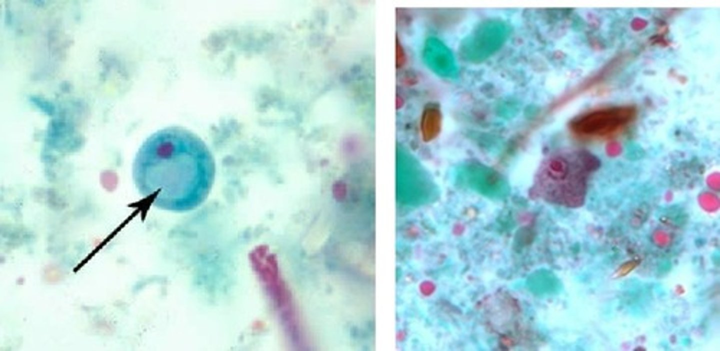 <p>• Cyst (left)</p><p>o No peripheral chromatin</p><p>o Prominent vacuole</p><p>• Trophozoite (right)</p><p>o 8-20 microns</p><p>o Vacuolated and granular</p>