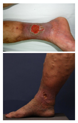 <ul><li><p>prolonged immobility</p></li><li><p>obesity</p></li><li><p>calf muscle pump dysfunction</p></li><li><p>pregnancy</p></li></ul><p></p>