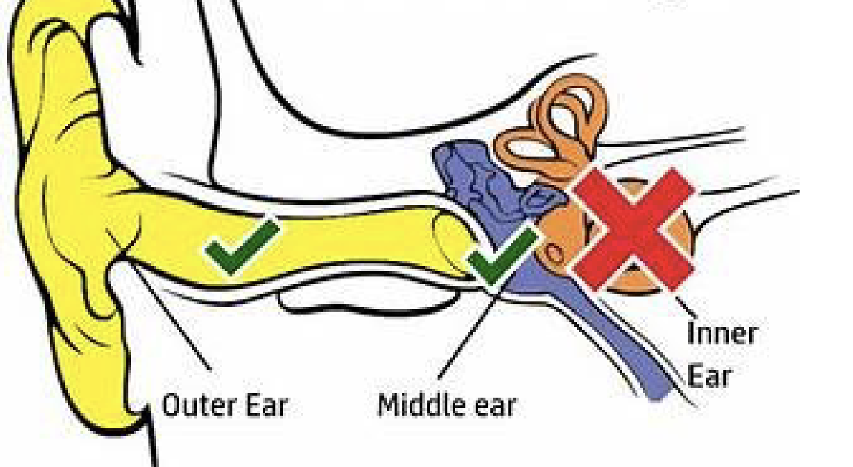 <p>What kind of hearing loss is this?</p>