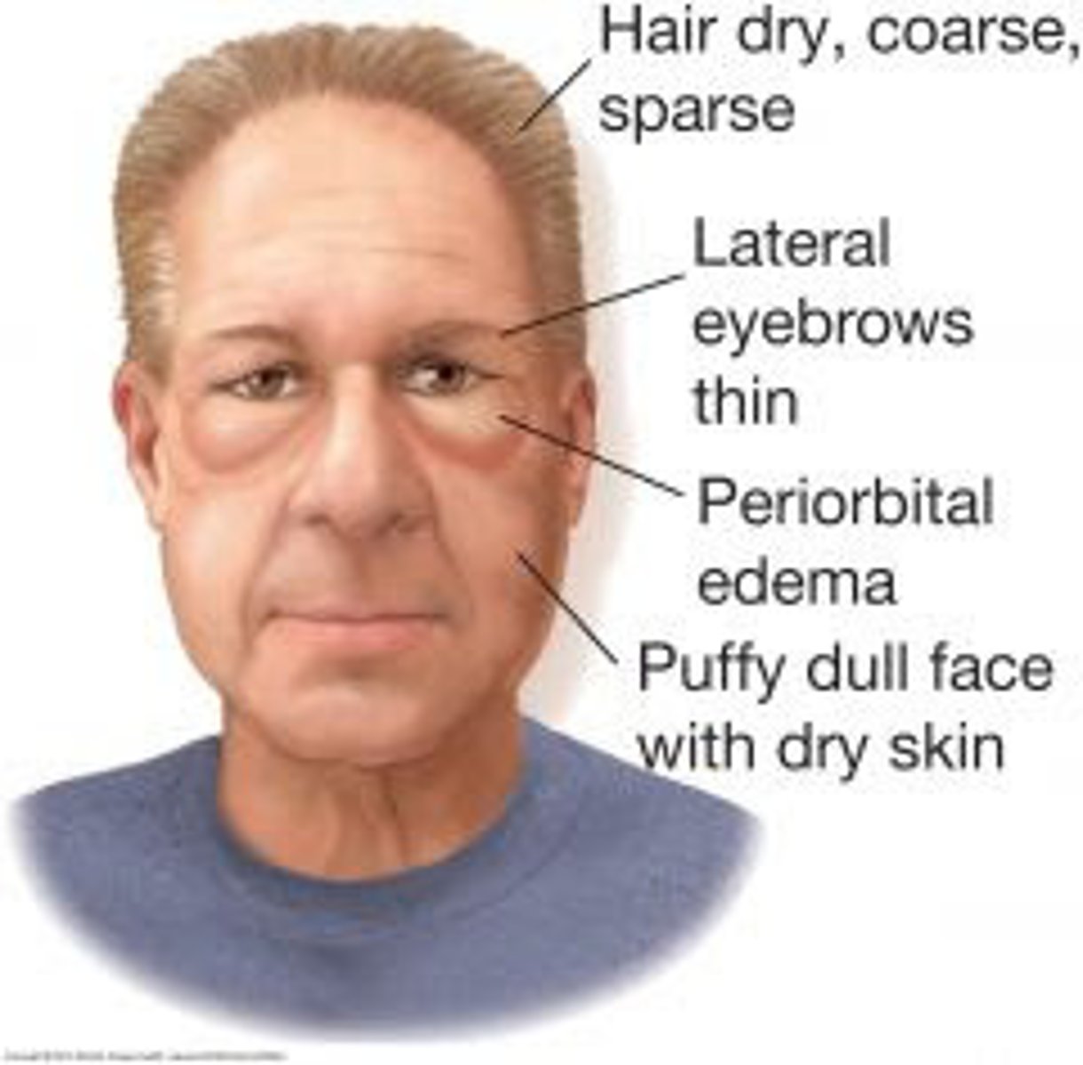 <p>Myxoedema</p>