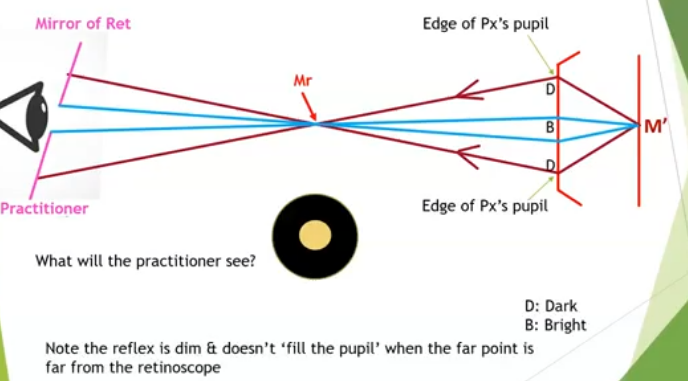 <p>mr is between patient and practitioner so against movements seen&nbsp;</p><p>only the blue rays go into the practitoners eyes meaning will see a small pupil reflex as nt all light is passing into the eye&nbsp;</p>