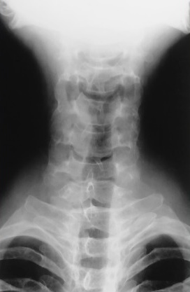 <p>What is this x-ray demonstrating?</p>