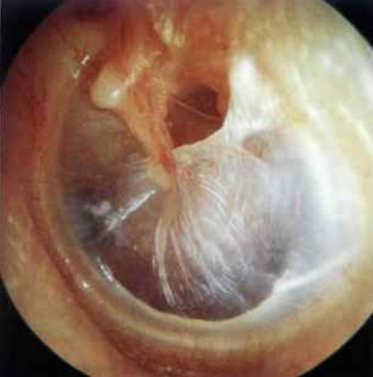<p>A condition where the eardrum becomes thin or hard, affecting hearing.</p>