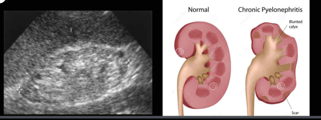 <p>What does the following sonographic appearance describe?</p><p><span>• Decreased renal size</span><br><span>• Unilateral or bilateral focal areas of cortical thinning and increased echogenicity.Overlying cortical atrophy/scarring</span><br><span>• hypertrophy of contralateral kidney</span></p>