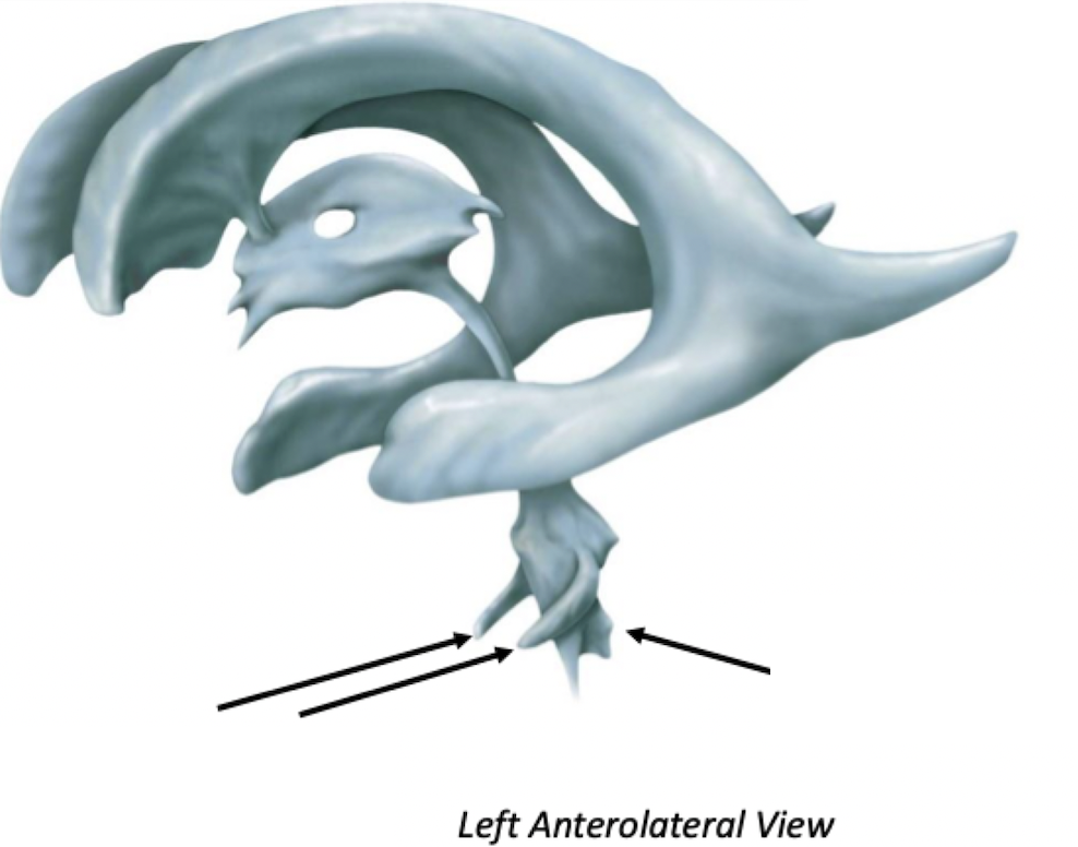 <p>Fourth Ventricle</p>