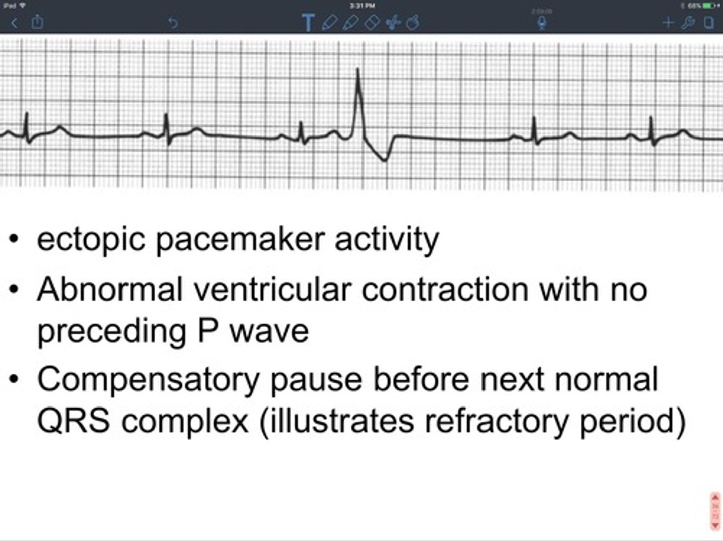 <p>some cells contain special ionic channels which open or close spontaneously and rhythmically without external stimulation which results in a threshold depolarization at the initial segment</p>