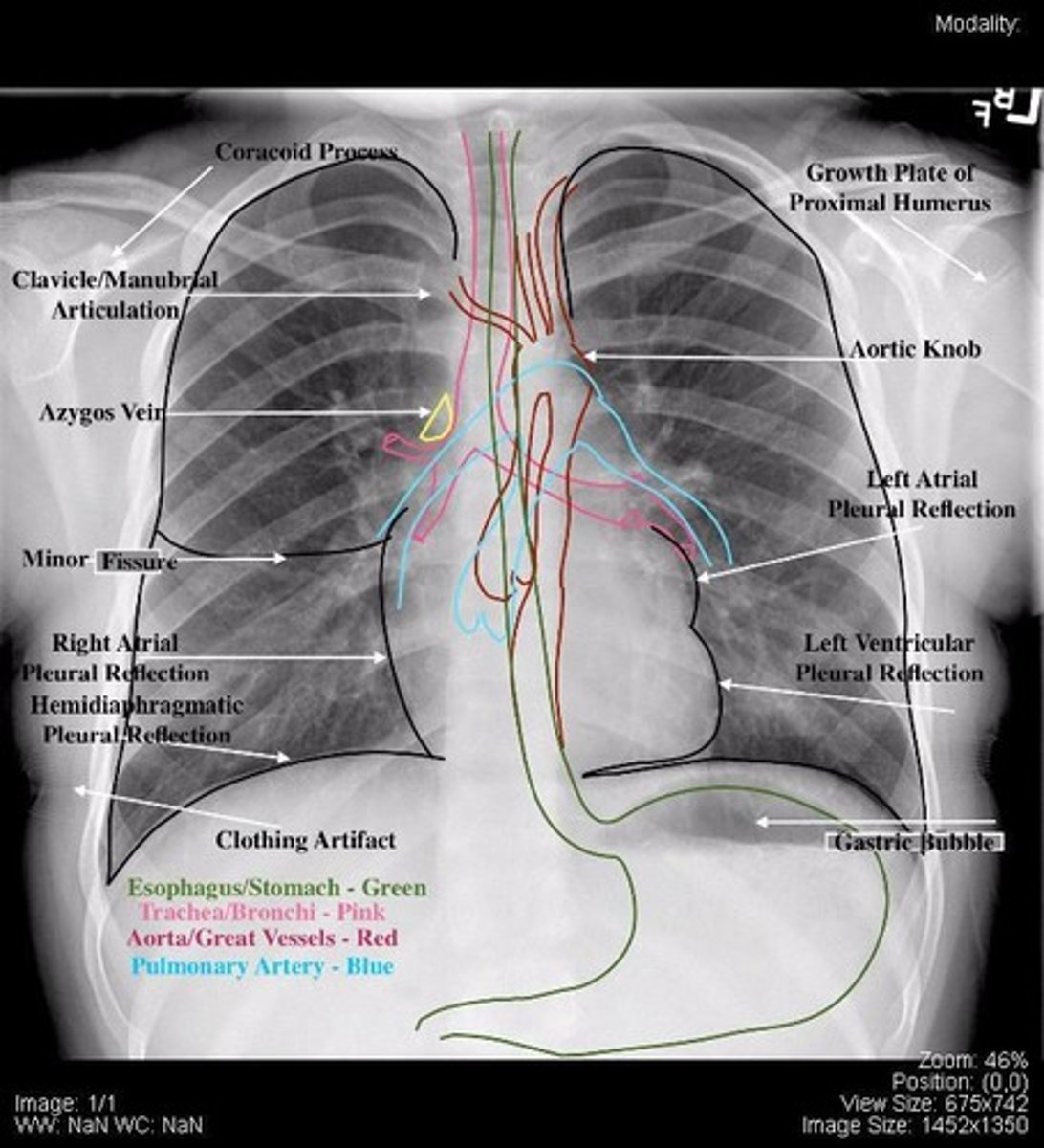 <p>Chest X-ray</p>