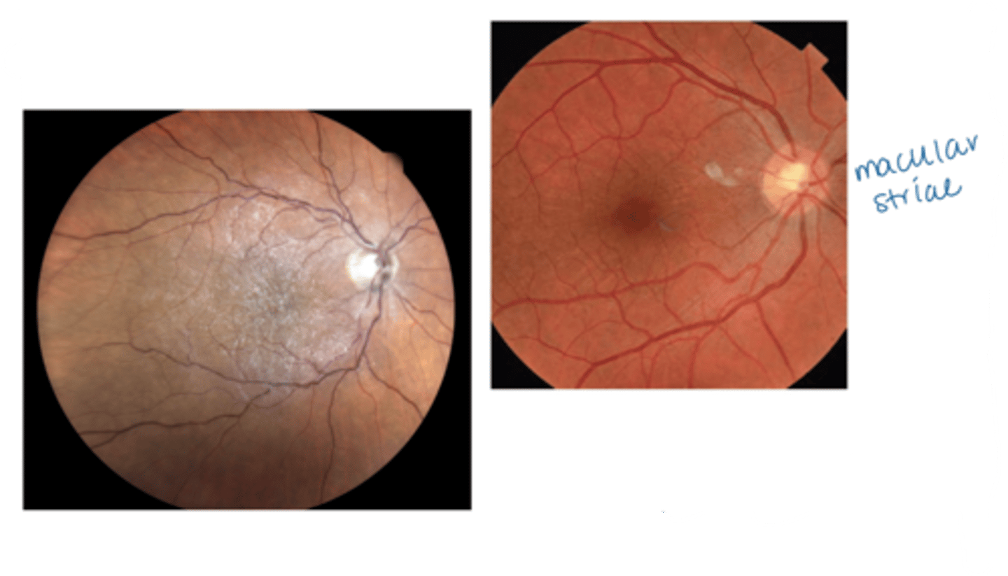 <p>glistening sheen, abnormal reflectivity (focal or diffuse)</p><p>appears opaque when severe</p><p>+/- retinal wrinkling, striae</p><p>+/- pseudohole</p><p>+/- cystoid macular edema</p><p>+/- serous detachment</p>