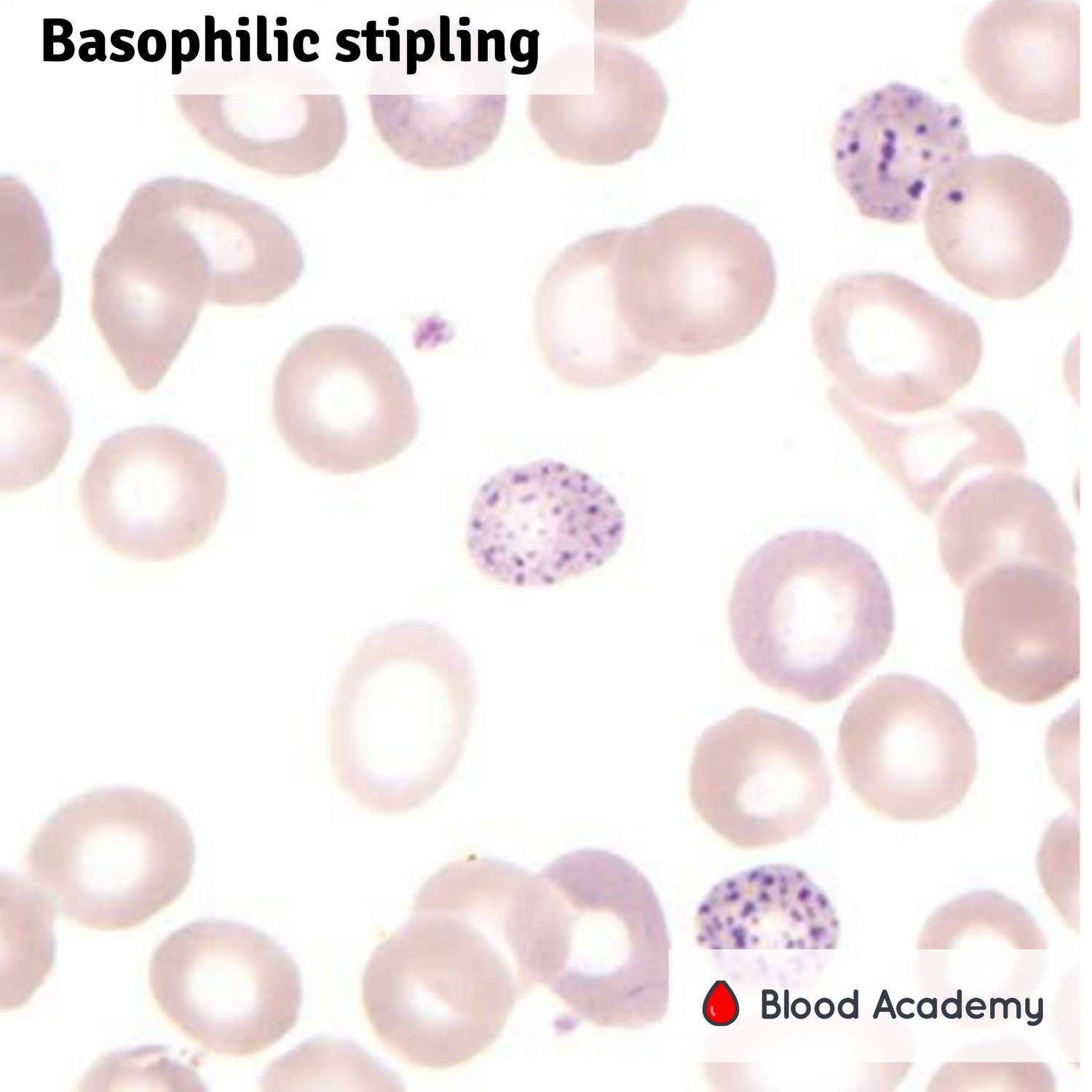 <ul><li><p>composed of RNA and mitochondrial remnants</p></li><li><p>course-looking in appearance, granular</p></li><li><p>caused by lead intoxication or thalassemia</p></li></ul><p></p>
