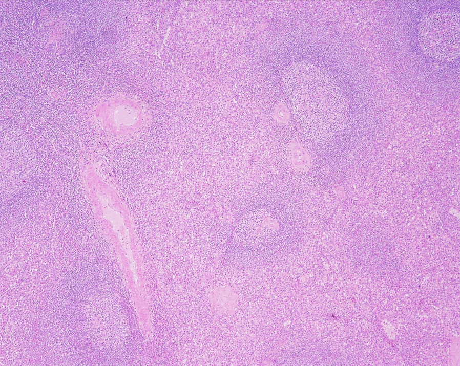 <p><strong>Spleen</strong></p><p><em>Lymphatic nodule &amp; germinal center observed</em></p>