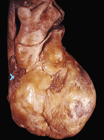 <p>What is X’s location inside the heart? (not superficial)</p><p></p>