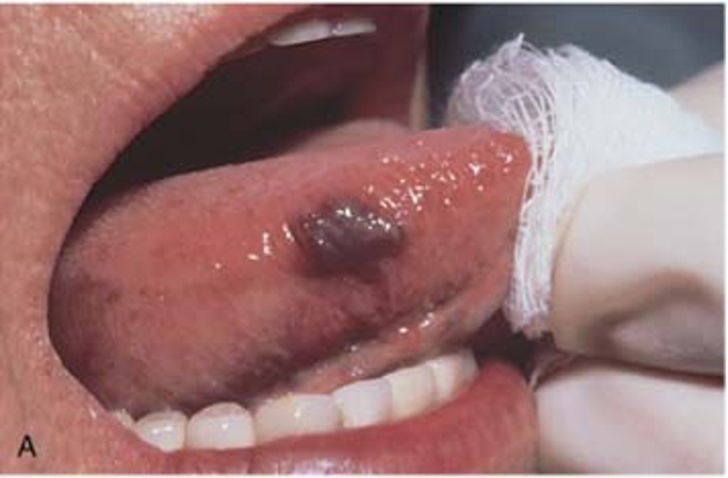 <p>MOST COMMON TUMOR IN CHILDREN!</p><p>• red (changes to purple), rubbery, elevated mass</p><p>• INVOLUTES OVER TIME</p><p>• common location: tongue </p><p>• population: children</p>