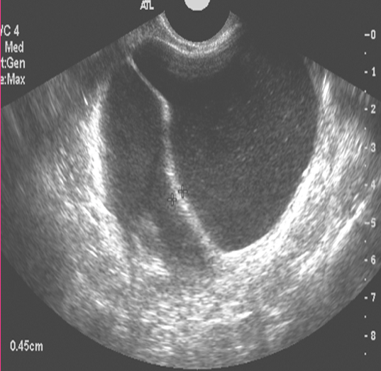 <p>What is the most common cystic tumor measuring 15-30cm, thin-walled, filled with gelatin-like material and multilocular spaces?</p>