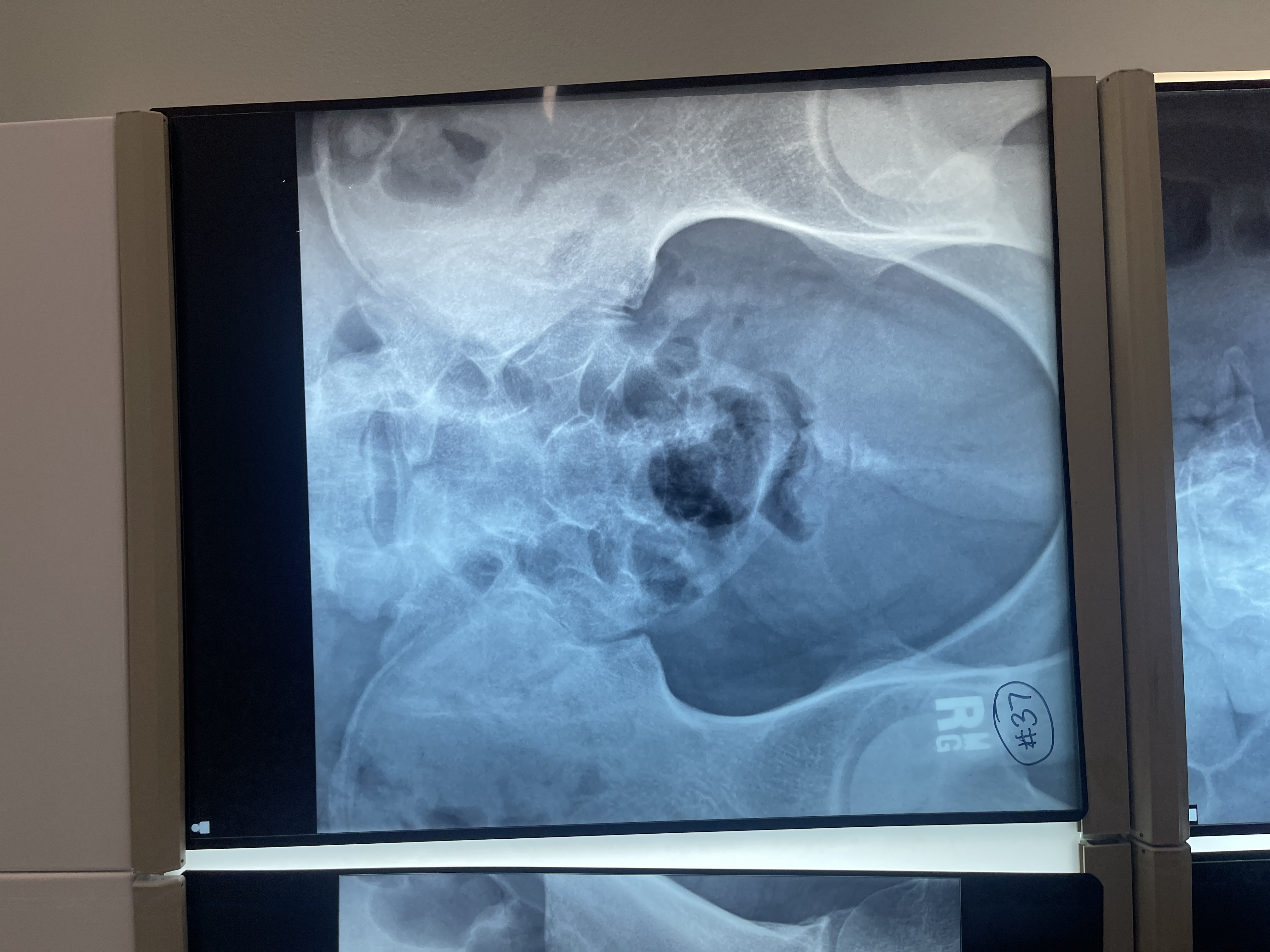 <p>What’s wrong with #37 AP axial coccyx</p>
