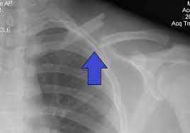 <p>Diagnose this injury. Provide Moi, signs and symptomsand management </p>