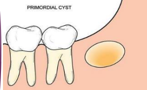 <p>What other lesion shares microscopic features with primordial cyst?</p>