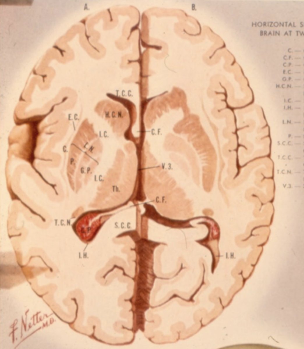 <p>posterior limb of internal capsule</p>