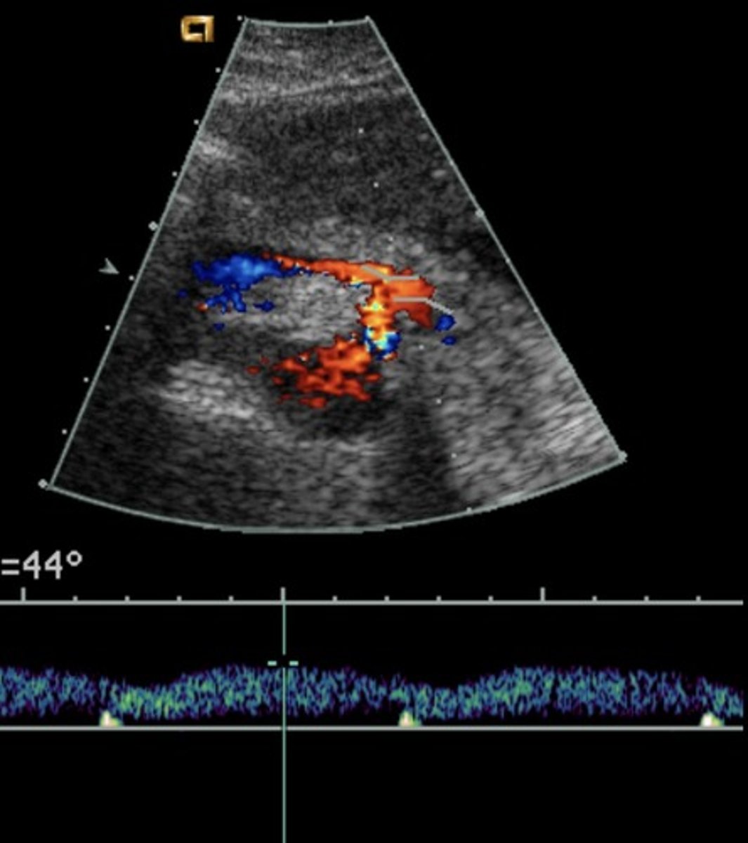 <p>Hepatopetal flow</p><p>Continuous monophasic with slight respiratory variation</p>