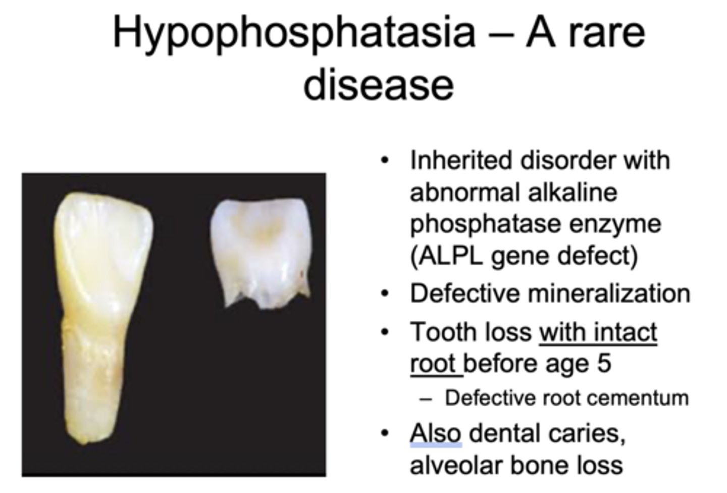 <p>Hypophosphatasia</p>