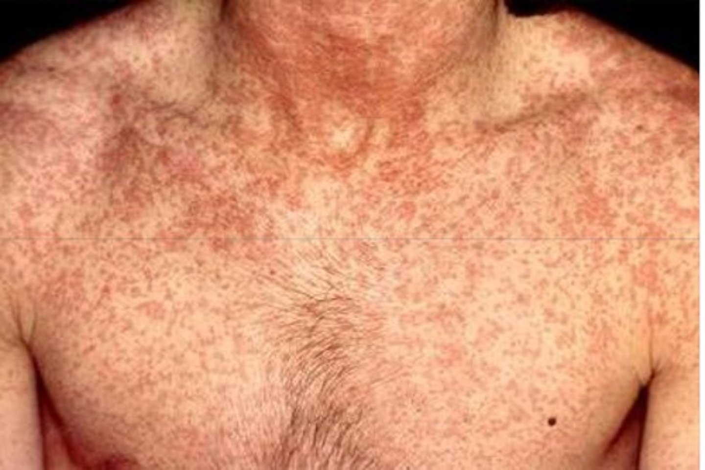 <p>Measles/Rubeola (Koplik Spots)</p>