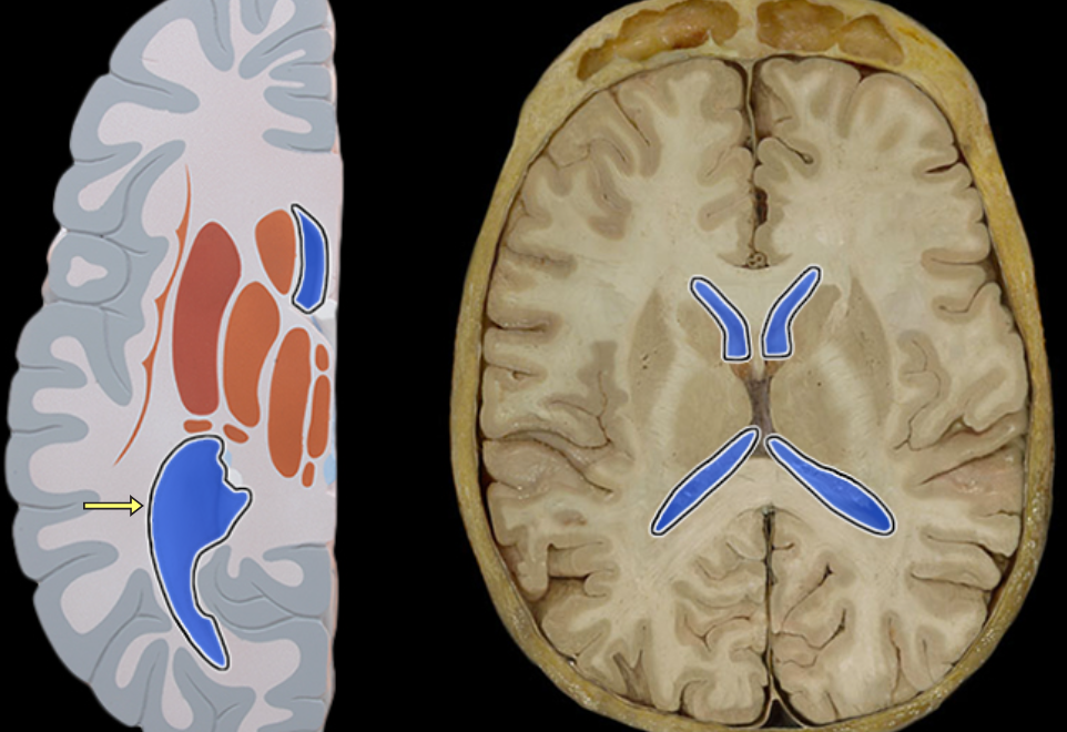 <p>Lateral ventricle</p>