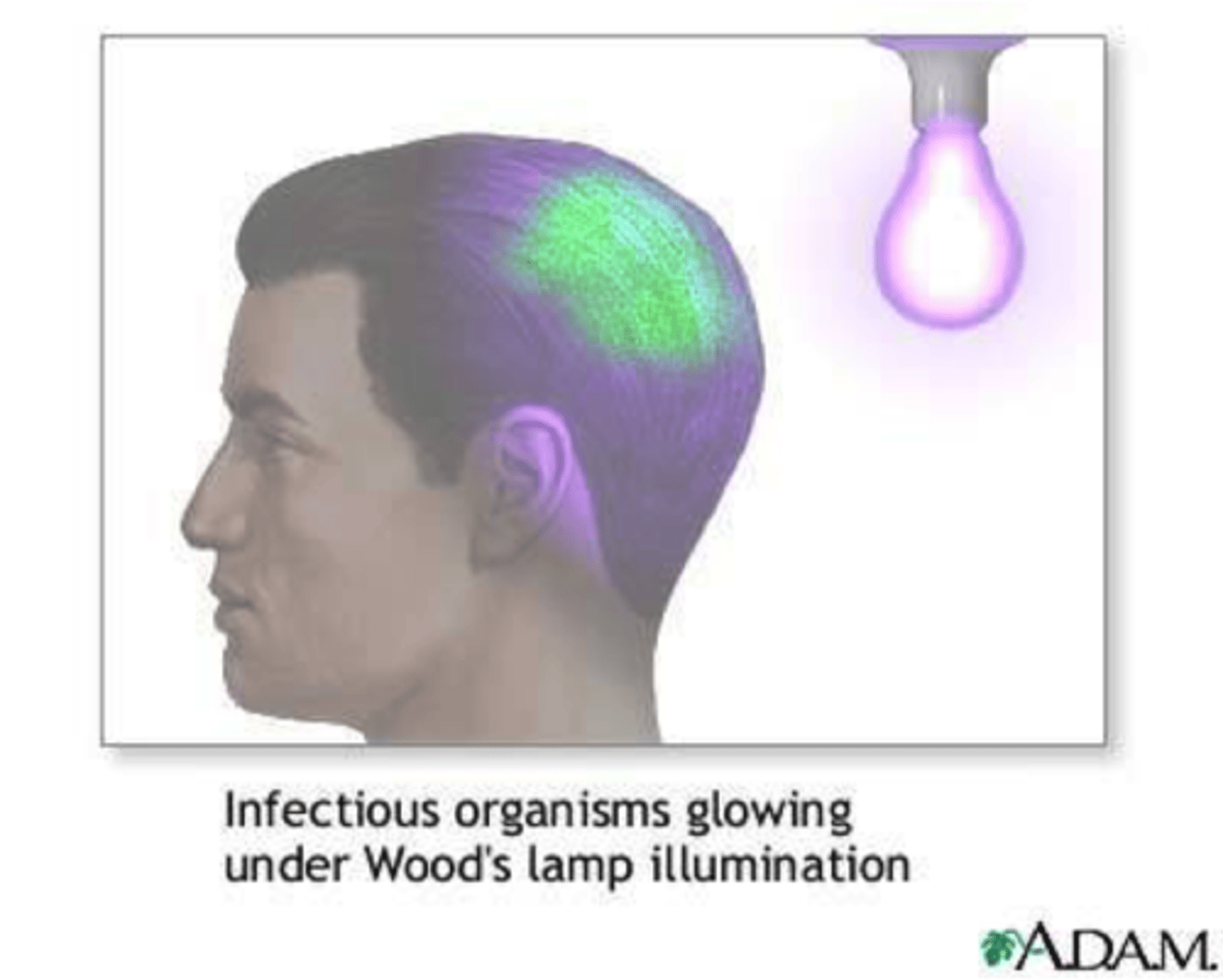 <p>Wood's black light</p><p>Detecting infected hairs by fluorescing a bright, yellow-green</p><p>Wash affected skin sites with 70% isopropanol</p><p>- Obtain small fragments / scales</p><p>Skin or nail</p><p>Scrape with scalpel or slide</p><p>Mince as needed</p><p>- Add KOH and coverslip</p><p>- Heat may accelerate clearing process (may be overdone!)</p><p>Nails may require 30 minutes.</p><p>Press coverslip gently, express bubbles</p><p>- Clearing apparent as change in preparation to turbid</p><p>Thick, opaque samples</p><p>Unsatisfactory for examination</p><p>Obscured hyphae and spores</p>