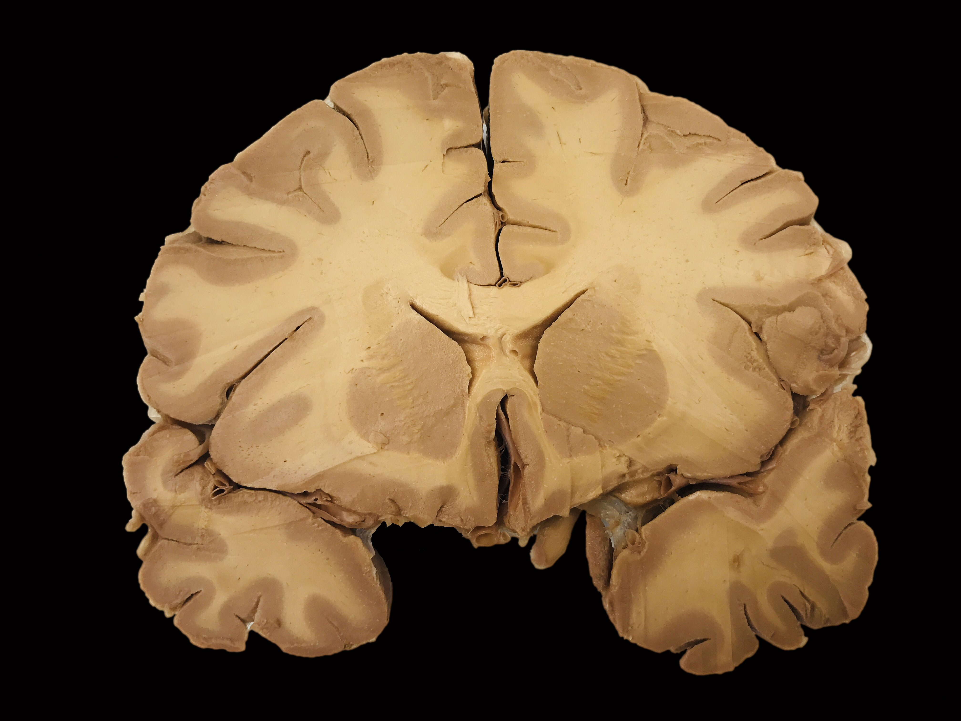 what type of brain does this MRI show