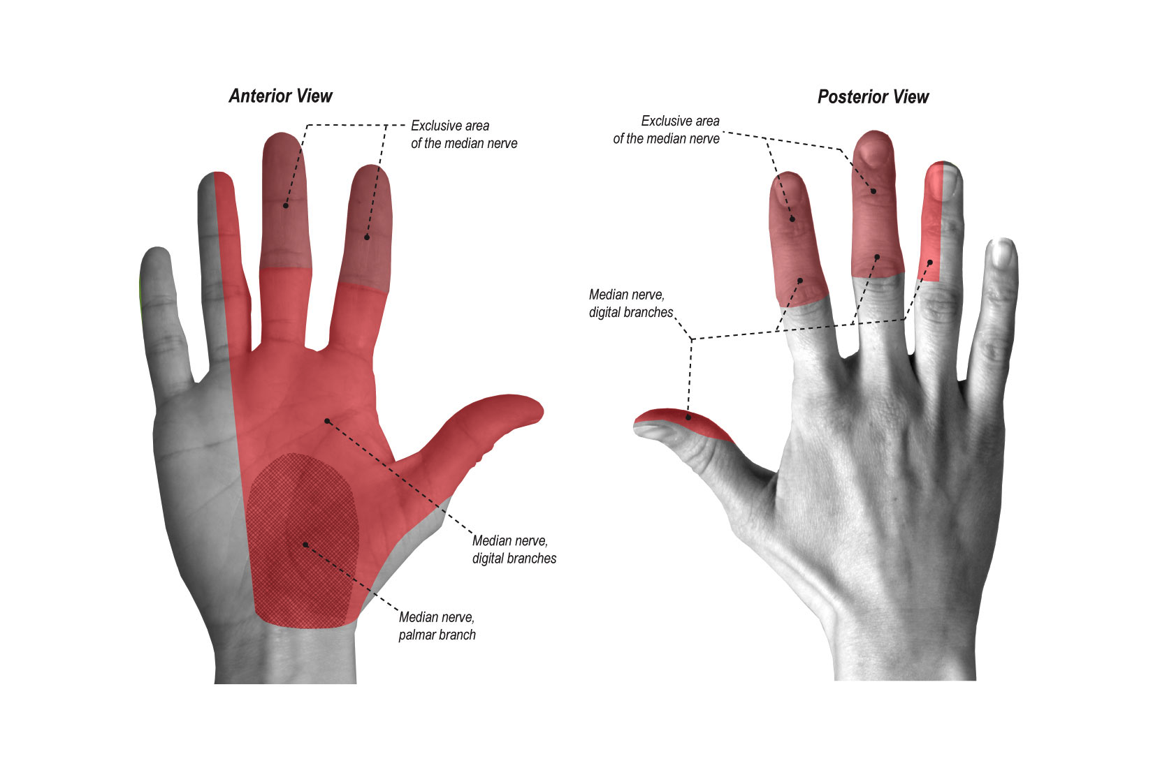 <ul><li><p><strong><mark data-color="purple" style="background-color: purple; color: inherit">sensory loss to</mark></strong></p><ul><li><p>central palm, digits 1-3, and half of digit 4</p></li><li><p>dorsal middle &amp; distal phalanges of digits 2,3, and half 4</p></li></ul></li><li><p><strong><mark data-color="purple" style="background-color: purple; color: inherit">motor loss</mark></strong></p><ul><li><p>LOW</p><ul><li><p>MCP flexion of digits 2-3</p></li><li><p>thumb opposition, abduction and flexion of MCP (weak pinch)</p></li></ul></li><li><p>HIGH</p><ul><li><p>flex of DIP at digits 1-3</p></li><li><p>flex of radial wrist</p></li></ul></li></ul></li><li><p><strong><mark data-color="purple" style="background-color: purple; color: inherit">deformity</mark></strong></p><ul><li><p>flat thenar eminence</p></li><li><p><strong>claw </strong>of index and middle finger</p></li></ul></li><li><p><strong><mark data-color="purple" style="background-color: purple; color: inherit">OT tx</mark></strong></p><ul><li><p>orthosis, A/PROM, strengthening, scar management, sensory re-education</p></li></ul></li></ul><p></p>