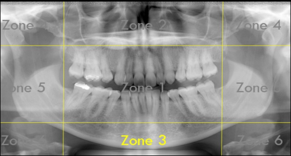 <p>Zone 3: The Mandible</p>