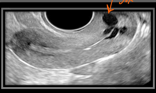 <p>Nabothian cysts originate from the ______ and are considered ______</p>