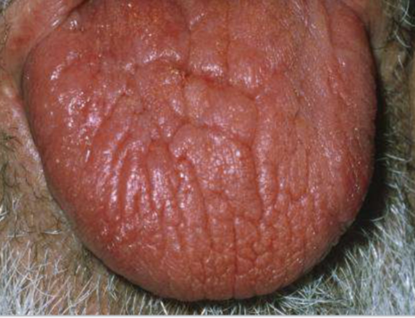 <p>Patient reported undergoing radiotherapy a few weeks ago. What do you suspect?</p>