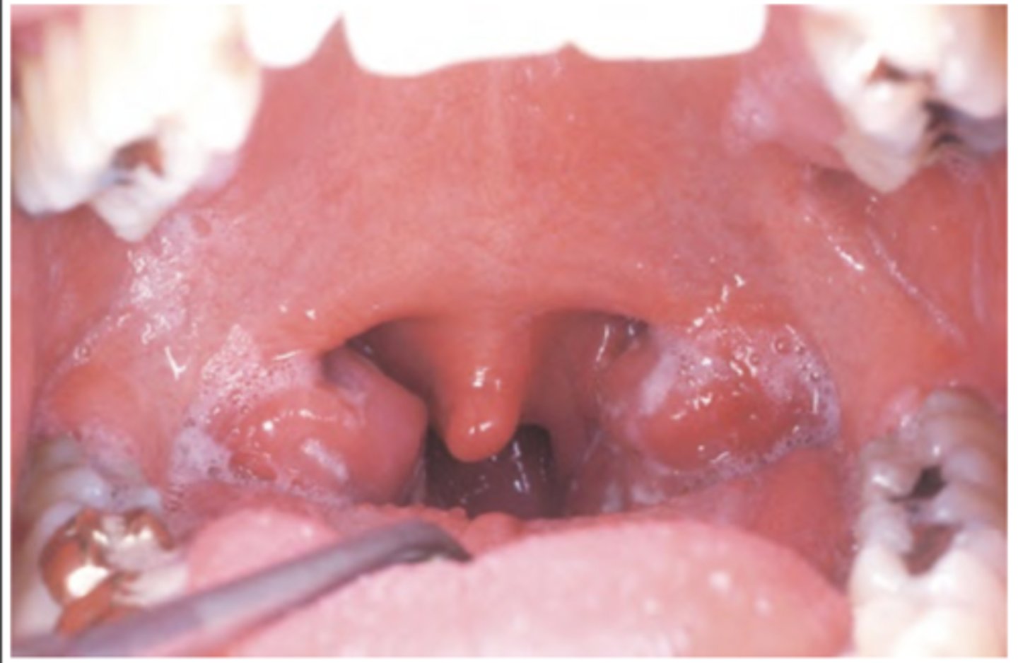 <p>Hint: oropharyngeal tonsillar enlargement and lymphoid hyperplasia</p>