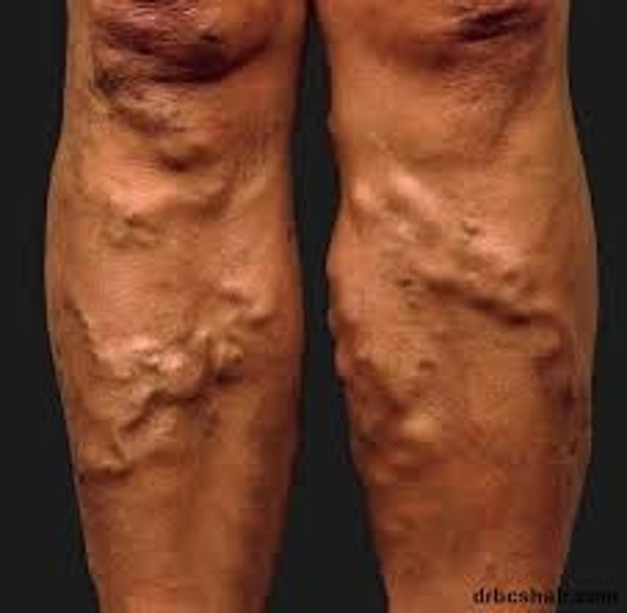 <p>les varices</p>