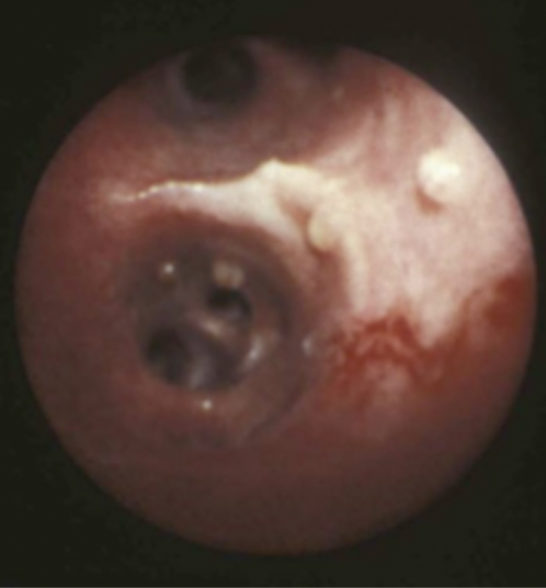 <p>A 2 year old poodle mix presented with a chronic dry cough. The owner believes it is worse on mornings when the air is cooler. Bronchoscopy reveals nodules in the trachea and bronchi that look like this. What parasite is implicated?</p>