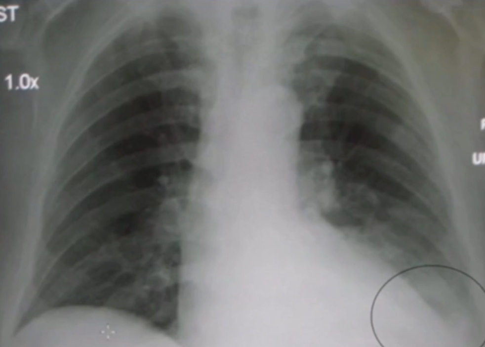 <p>What is the diagnosis based off of this chest x-ray?</p>