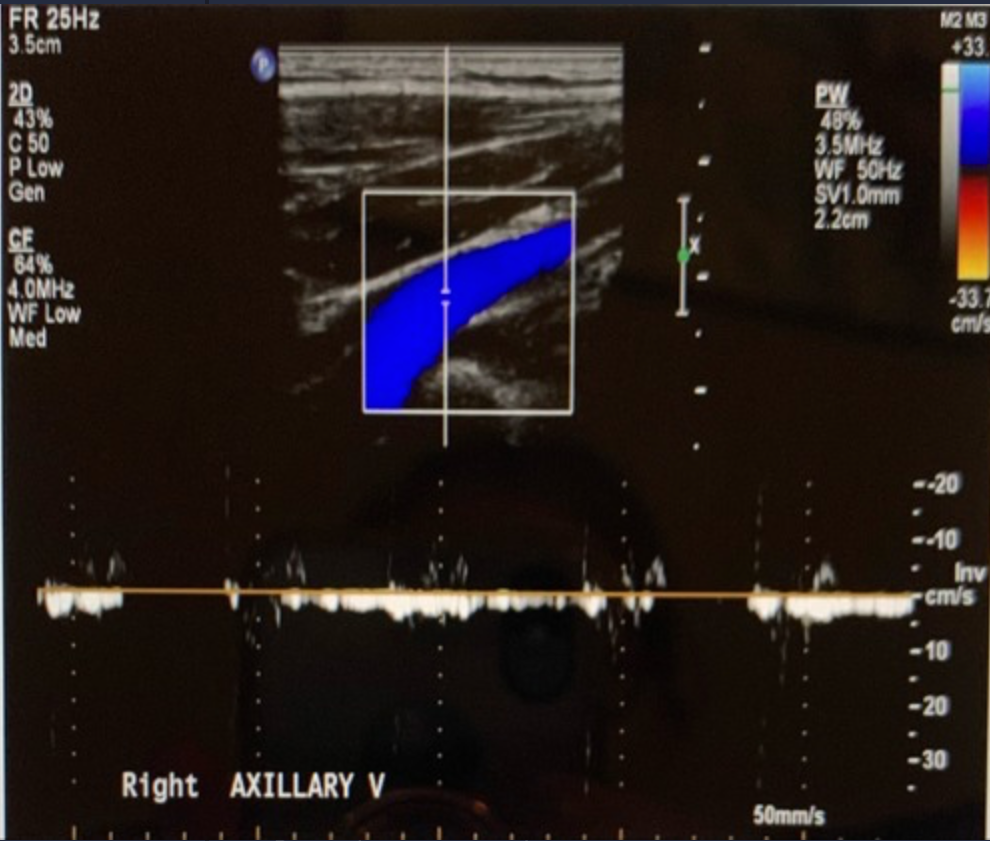 <p>What console control should be adjusted to improve the quality of the Doppler tracing?</p><p>a. increase the PW Doppler scale <br>b. adjust the placement of the Doppler cursor so it is more parallel to the blood flow<br>c. raise the baseline<br>d. reduce the wall filter setting</p>