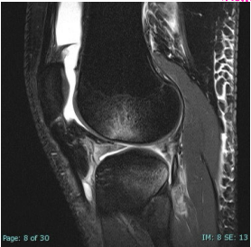 <p>What does this show?</p><p>-Hint: a classic sign of ACL tear</p>