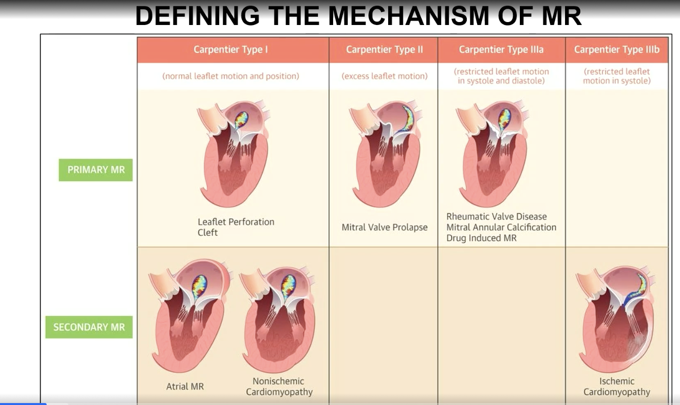 <p>Restricted leaflet motion in systole and diastole</p>