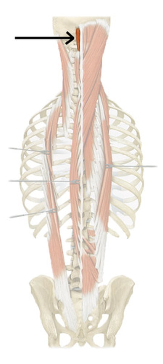 <p>spinous process of Cervical 7-Thoracic 1 vertebrae</p>