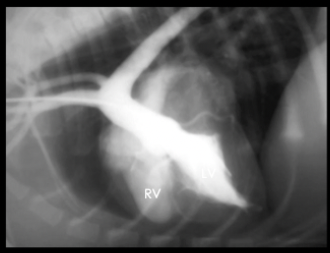 <p>What can be seen in this angiogram?</p>