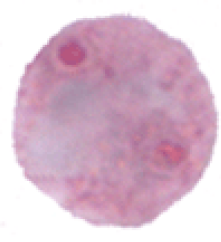<p>Trophozoite ONLY</p><ul><li><p>2 nuclei</p></li><li><p>inclusions possible</p></li></ul><p></p>
