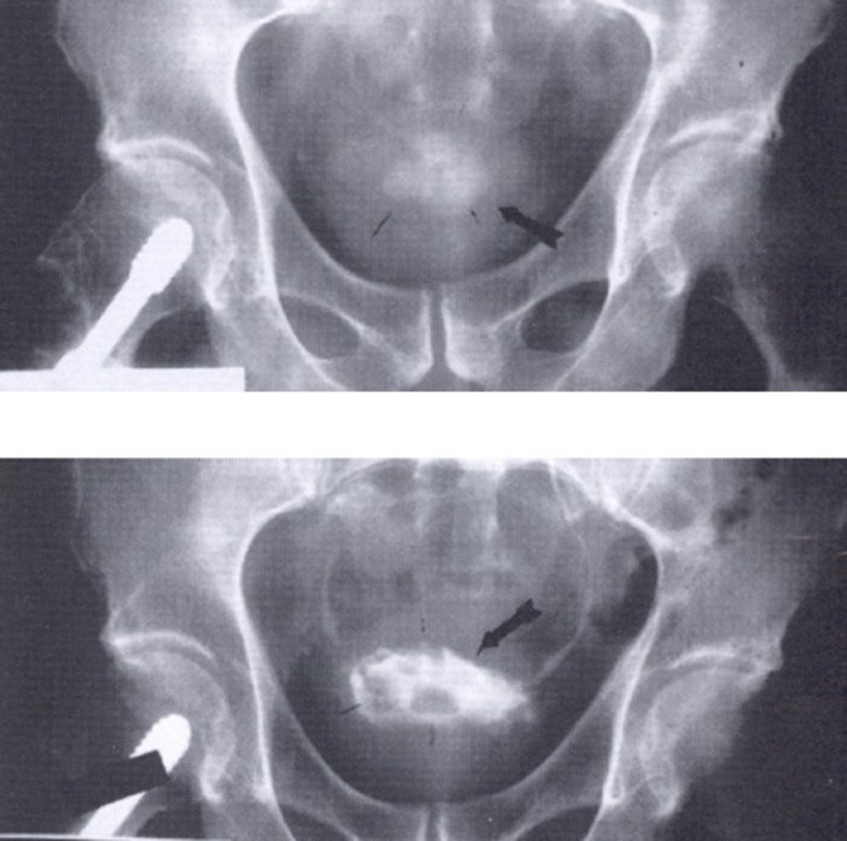 <p>What occurs in men with obstruction and urinary tract infections (UTI) that varies in size and number?</p>