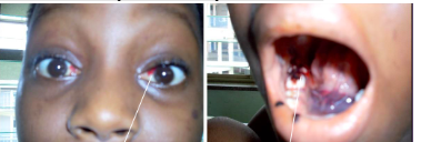 <p><span style="background-color: transparent; font-family: "Times New Roman", serif;"><u>SYSTEMIC</u>:</span></p><p><span style="background-color: transparent; font-family: "Times New Roman", serif;">1. <strong>Anemia</strong> → fatigue, lightheadedness, weakness</span></p><p><span style="background-color: transparent; font-family: "Times New Roman", serif;">2. <strong>Neutropenia</strong> → bacterial & fungal infections</span></p><p><span style="background-color: transparent; font-family: "Times New Roman", serif;">3.<strong> Thrombocytopenia</strong> → bleeding, bruising</span></p><p></p><p><span style="background-color: transparent; font-family: "Times New Roman", serif;"><u>ORAL</u>:</span></p><p><span style="background-color: transparent; font-family: "Times New Roman", serif;">1. Anemia → <strong>mucosal pallor</strong></span></p><p><span style="background-color: transparent; font-family: "Times New Roman", serif;">2. Neutropenia → <strong>oral ulcerations with minimal peripheral erythema</strong></span></p><p><span style="background-color: transparent; font-family: "Times New Roman", serif;">3. Thrombocytopenia → <strong>gingival hemorrhage, mucosal petechiae, purpura</strong></span><br></p><p><span style="background-color: transparent; font-family: "Times New Roman", serif;">*Also see ecchymoisis of eye and mouth</span></p>