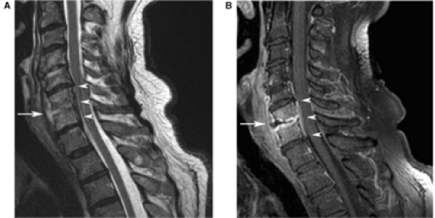 <p>infection of the bone and intervertebral discs</p>