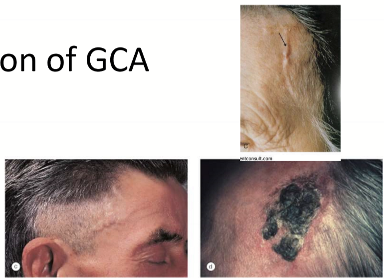 <ul><li><p>Scalp pain and potential necrosis</p></li><li><p>headache</p></li><li><p>jaw claudication/hurts to chew</p></li></ul><p></p>